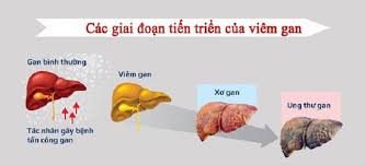 Khoảng từ 8-10% dân số Hải Dương nhiễm virus viêm gan